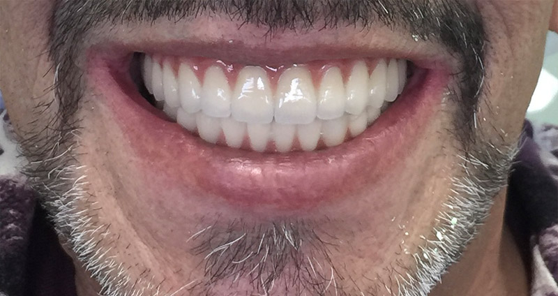 Dental Implants - Benjamin Bao Le, DMD, Wilmington Dentist