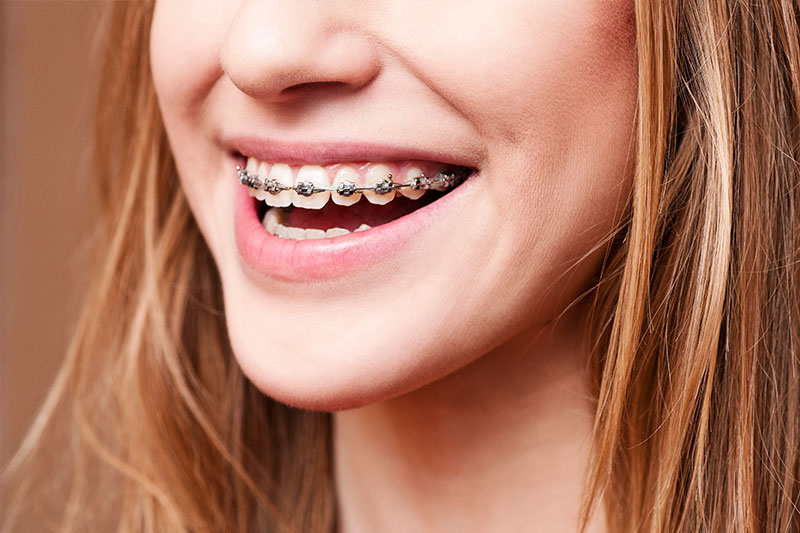 Transparent or Ceramic Braces in Wilmington - Wilmington