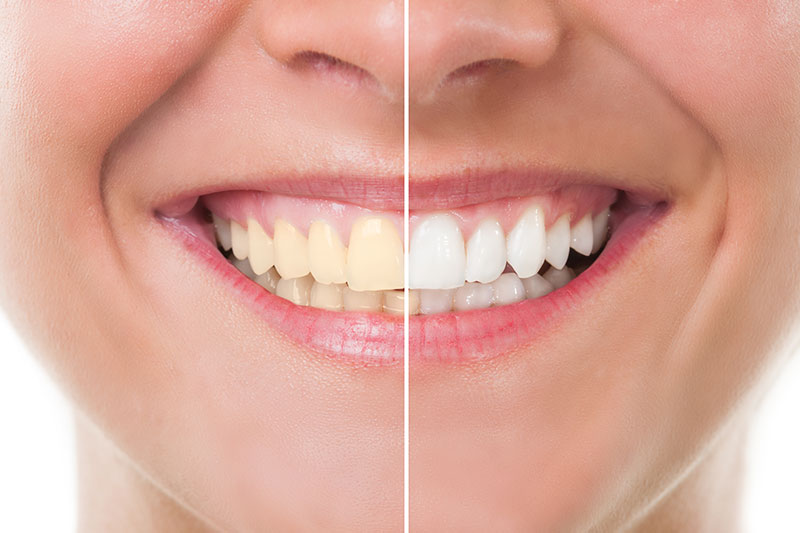 Teeth Whitening - Benjamin Le DMD, Wilmington Dentist